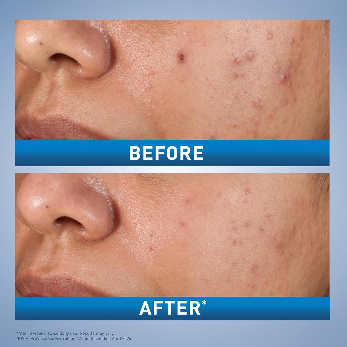 CeraVe Salicylic Acid Acne Treatment with Glycolic Acid and Lactic Acid | AHA/BHA Acne Gel for Face to Control and Clear Breakouts |1.35 Ounce - Vamzn#