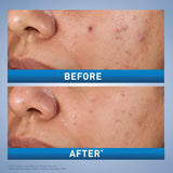 CeraVe Salicylic Acid Acne Treatment with Glycolic Acid and Lactic Acid | AHA/BHA Acne Gel for Face to Control and Clear Breakouts |1.35 Ounce - Vamzn#