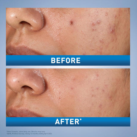 CeraVe Salicylic Acid Acne Treatment with Glycolic Acid and Lactic Acid | AHA/BHA Acne Gel for Face to Control and Clear Breakouts |1.35 Ounce - Vamzn#